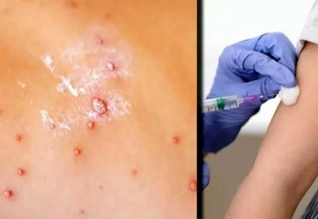 Fall3ce bebé en Tlaxcala por cuadro grave de sarampión